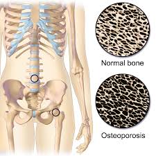 Día mundial de la Osteoporosis